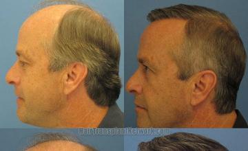 Left view before and after hair restoration pictures