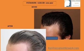 Hair transplantation surgery before and after pictures