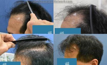 Hair transplantation surgery before and after photos