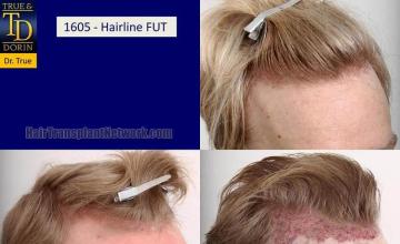 Hair transplantation surgery before and after photos