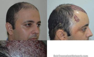 Hair transplantation surgery before and after photos