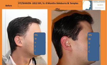 Hair transplantation surgery before and after pictures