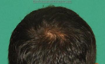 Hair transplantation surgery before and after images