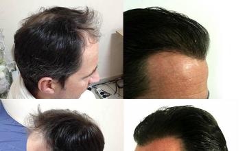 Hair restoration procedure before and after result photographs