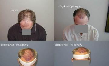 Hair transplantation surgery before and after images