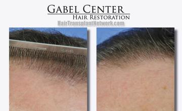 Hair restoration surgery before and after photos