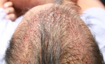 Hair restoration surgery before and after images