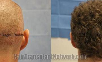 Hair transplantation surgery before and after pictures