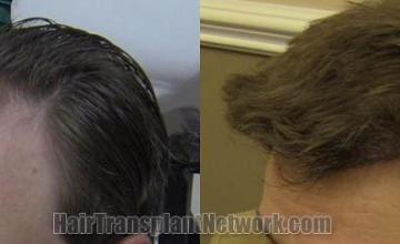 Hair transplantation surgery before and after pictures