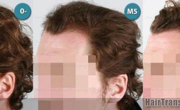 Hair transplantation surgery before and after images