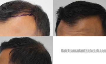 Hair transplantation surgery before and after pictures