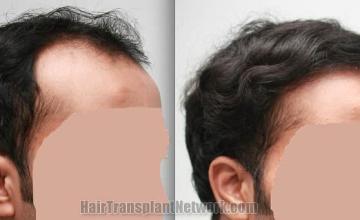 Hair transplantation surgery before and after images