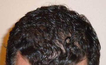 Hair restoration surgery before and after photos