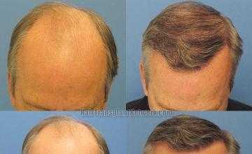 Top view pictures before and after hair transplant