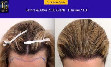 Hair transplantation surgery before and after images