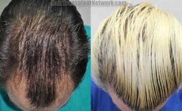 Hair restoration procedure before and after pictures