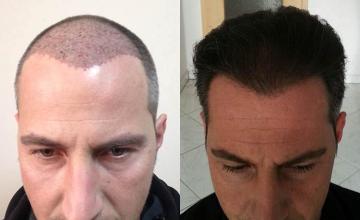 Hair restoration procedure before and after pictures