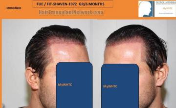 Hair transplant surgery before and after pictures