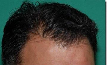 Hair restoration procedure results