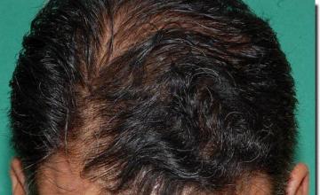 Hair restoration procedure results