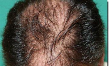 Hair restoration procedure results