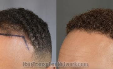 Before and after hair transplantation result photographs