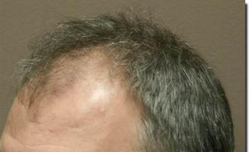 Hair restoration procedure results