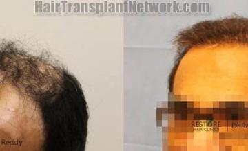 Hair transplantation surgery before and after images