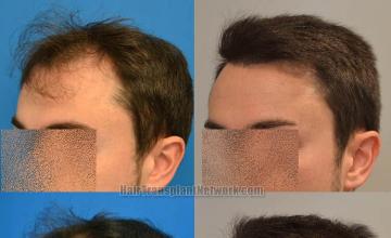 Hair transplantation surgery before and after images