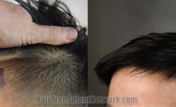 Before and after hair transplantation result photographs