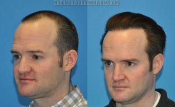 Hair transplantation surgery before and after photos