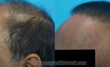 Before and after hair transplantation result photographs