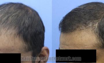 Before and after hair transplantation result photographs