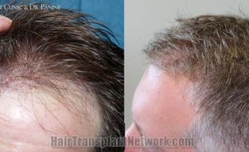 Before and after hair transplantation result photographs