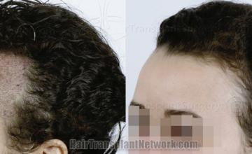 Before and after hair transplantation result photographs