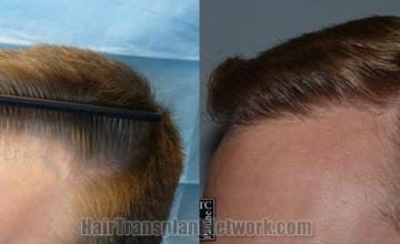 Before and after hair transplantation result photographs