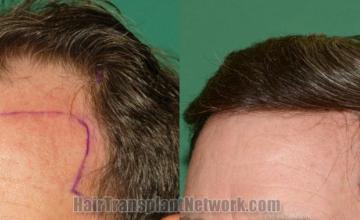 Before and after hair transplantation result photographs