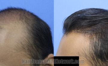 Before and after hair transplantation result photographs