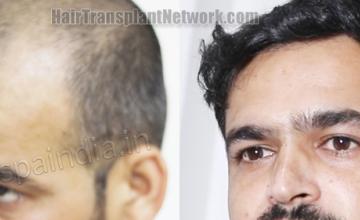 Before and after hair transplantation result photographs