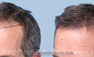 Before and after hair transplantation result photographs