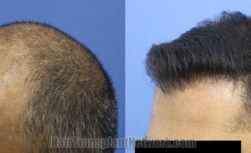 Before and after hair transplantation result photographs