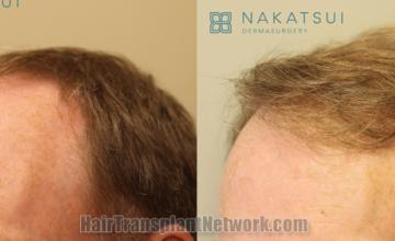 Before and after hair transplantation result photographs