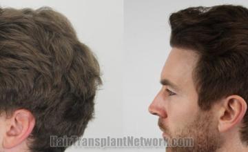 Before and after hair transplantation result photographs