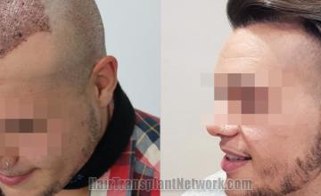 Before and after hair transplantation result photographs