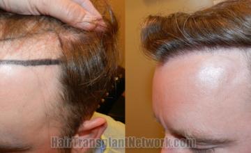 Before and after hair transplantation result photographs