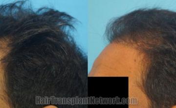 Before and after hair transplantation result photographs