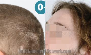 Before and after hair transplantation result photographs