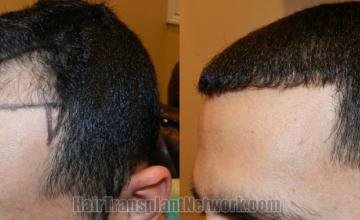 Before and after hair transplantation result photographs