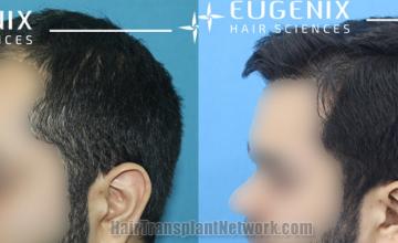 Before and after hair transplantation result photographs