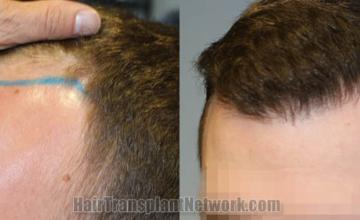 Before and after hair transplantation result photographs